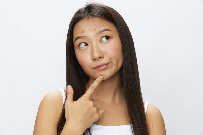 Vitamins for Acne