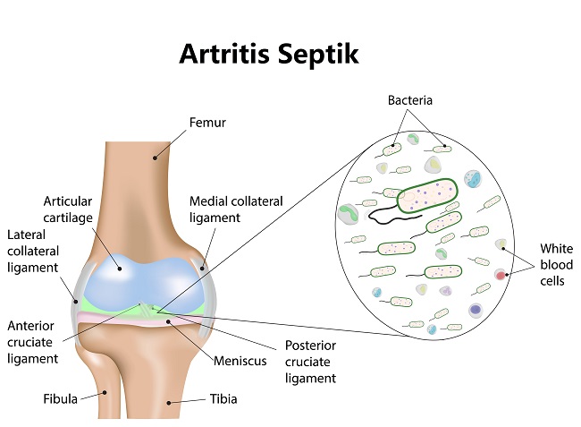 Diagnosis Artritis Septik Alomedika