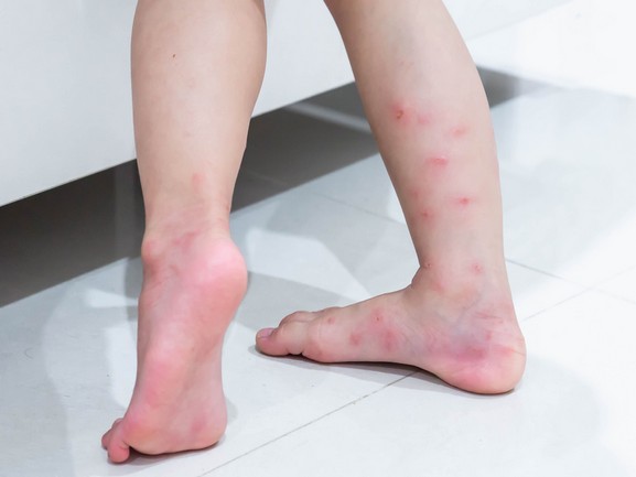 Allergic to Ants