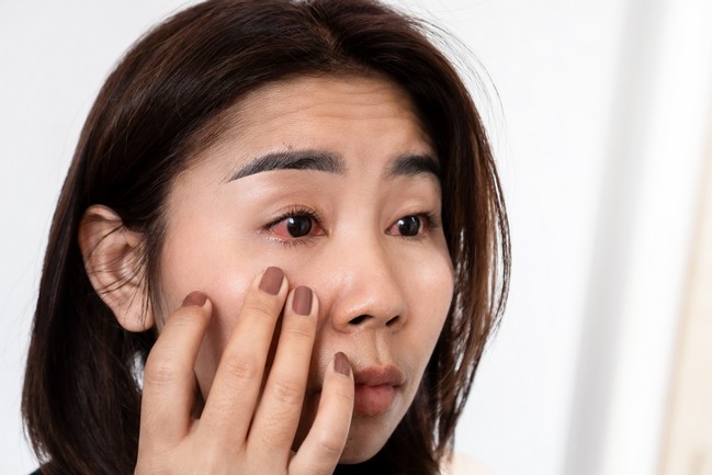 Allergic Conjunctivitis