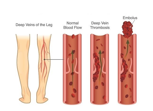 DVT