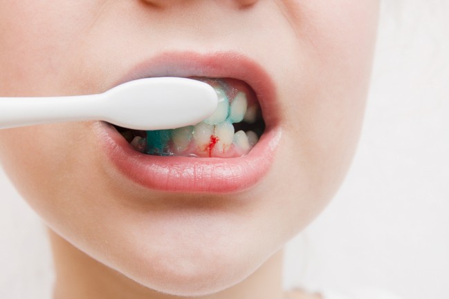 Brush your teeth and it bleeds