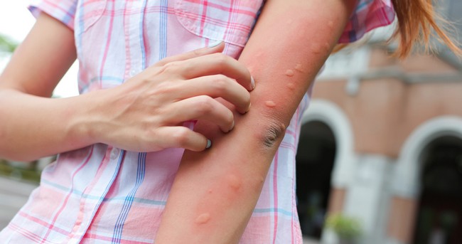 Itchy Bumps