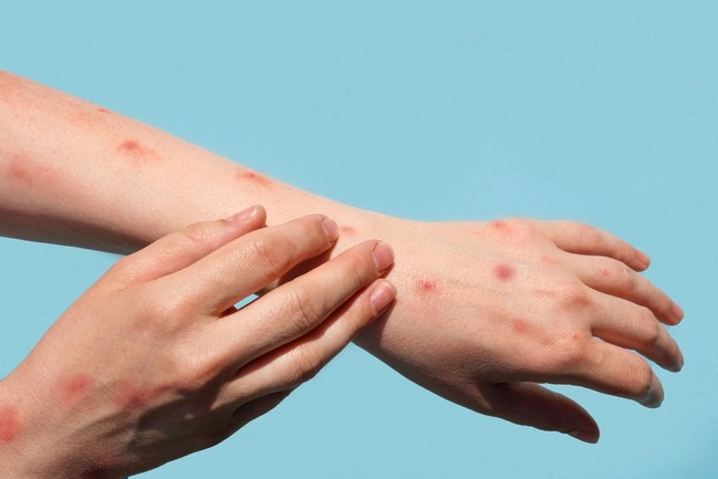 Early Symptoms of Mpox