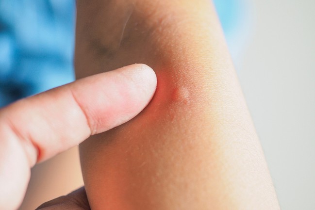 Ant bites