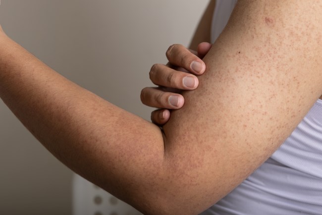 Keratosis Pilaris, Kenali Penyebab dan Penanganannya - Alodokter