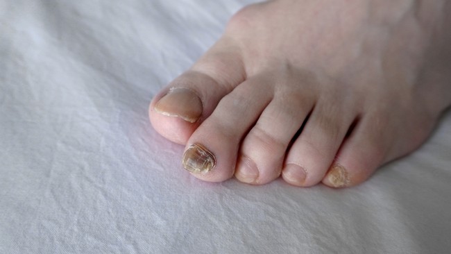 Signs of nail cancer