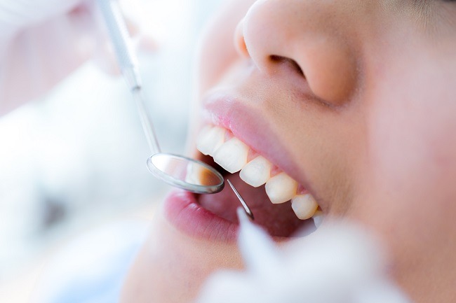 Splinting Gigi, Prosedur Penanganan untuk Gigi Goyang - Alodokter