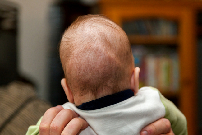 Craniosynostosis