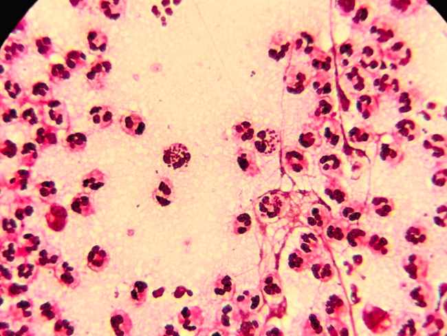 Neisseria gonorrhoeae, Bakteri Penyebab Gonore yang Patut Diwaspadai - Alodokter