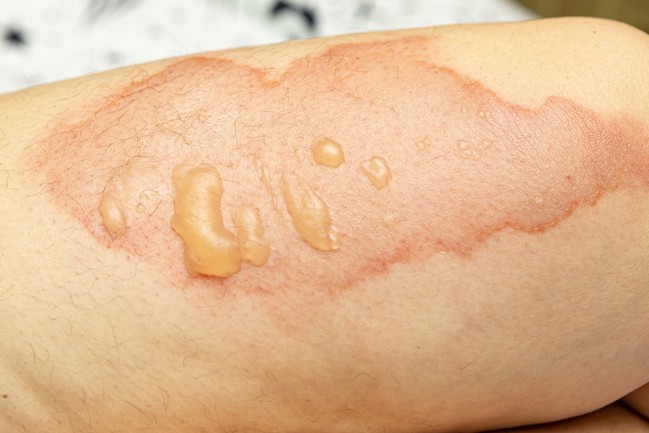 Scald Wound