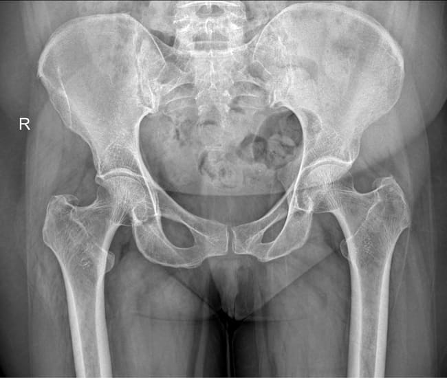 Edukasi Pasien Rontgen Pelvis - Alomedika