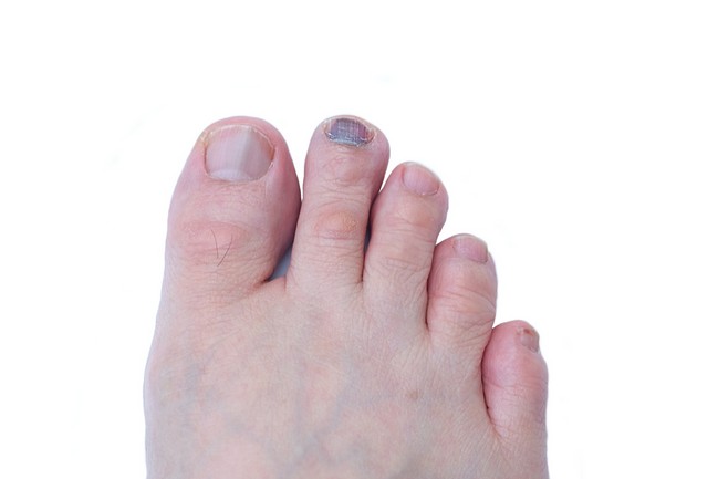Subungual Melanoma