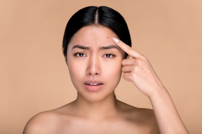 10 Penyebab Jerawat di Jidat yang Perlu Diketahui - Alodokter