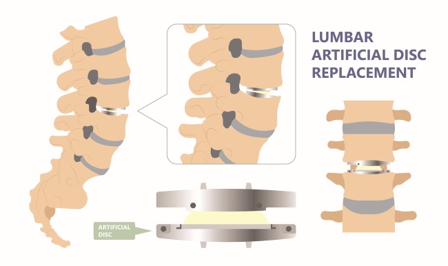 ACDF, Ini yang Harus Anda Ketahui - Alodokter