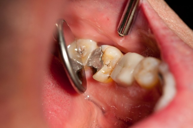 Broken molar