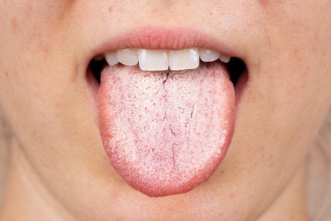 Oral Thrush