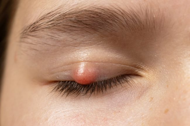 7 Penyebab Mata Bintitan dan Cara Mengatasinya - Alodokter