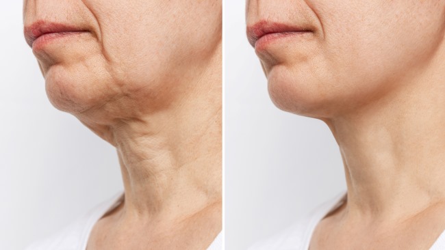 Neck Lift, Ini yang Harus Anda Ketahui - Alodokter