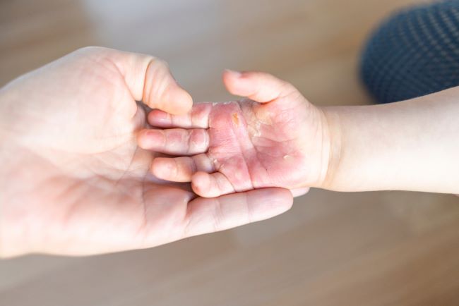 Balita Tersiram Minyak Panas, Ini Pertolongan Pertama yang Bisa Diberikan - Alodokter