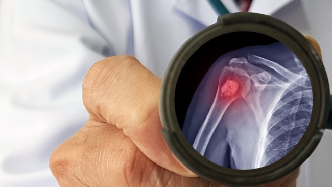 Tumor Tulang