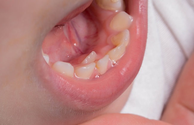 Hyperdontia