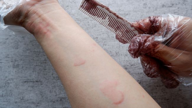 Apakah Alergi Cat Rambut Bisa Sembuh? Ini Jawabannya - Alodokter