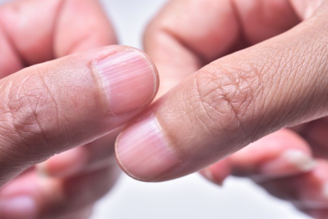 Kuku Bergaris, Kenali Penyebab dan Penanganannya - Alodokter