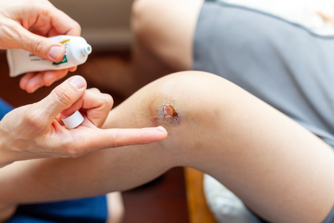 12 Obat Luka Bernanah dan Bengkak yang Efektif Atasi Keluhan - Alodokter