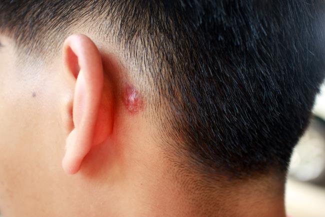 Benjolan di Belakang Telinga pada Anak, Kenali Penyebab dan Penangannya - Alodokter