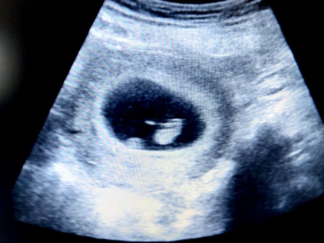 Janin 6 Minggu, Inilah Perkembangan dan Tips Menjaga Kesehatannya