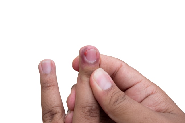 7 Cara Mengobati Cantengan Bernanah di Jari Tangan yang Efektif - Alodokter