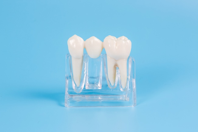 Dental Bridge, Ini Jenis dan Manfaatnya - Alodokter