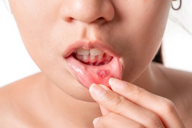 11 Makanan untuk Menyembuhkan Sariawan yang Bernutrisi - Alodokter