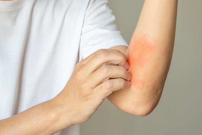 7 Cara Mengobati Jamur Kulit yang Membandel agar Hilang Sepenuhnya - Alodokter