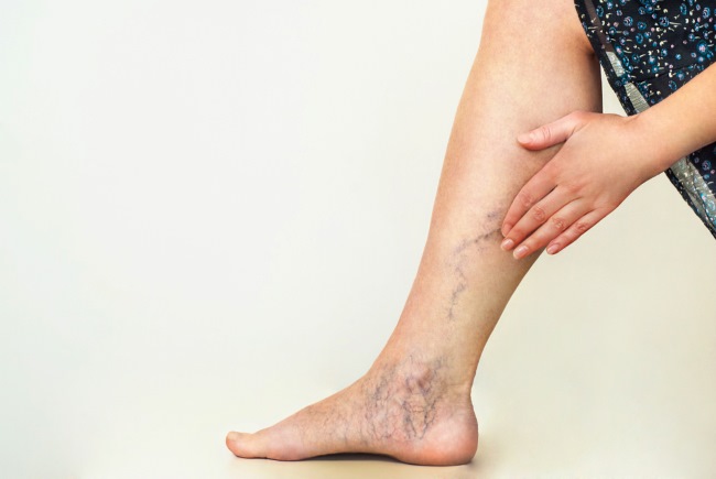 Spider Vein, Ketahui Penyebab dan Penanganannya - Alodokter