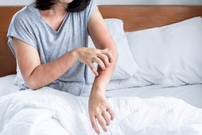 Gigitan Tungau Kasur: Gejala, Cara Mengatasi, dan Pencegahan - Alodokter
