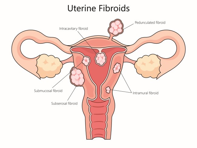 Mioma Uteri