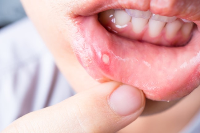 5 Minuman untuk Sariawan agar Luka Cepat Sembuh - Alodokter