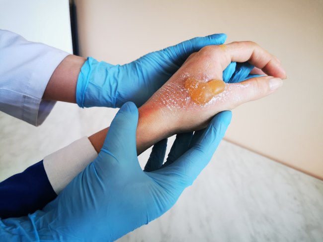 6 Cara Mengobati Kulit Melepuh dan Berair yang Aman - Alodokter