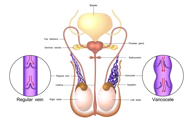 Operasi Varikokel, Ini yang Harus Anda Ketahui - Alodokter