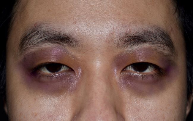 Racoon Eyes, Kenali Penyebab, Gejala, dan Penanganannya - Alodokter
