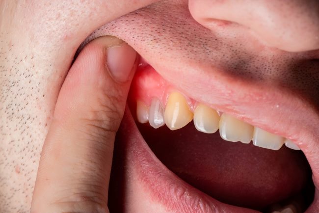 5 Akibat Gusi Bengkak yang Perlu Diwaspadai - Alodokter