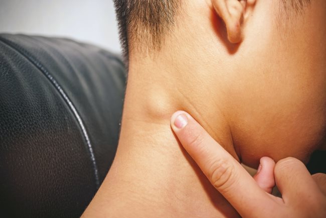 Benjolan di Leher Belakang Bawah Rambut, Ini Penyebab dan Penanganannya - Alodokter