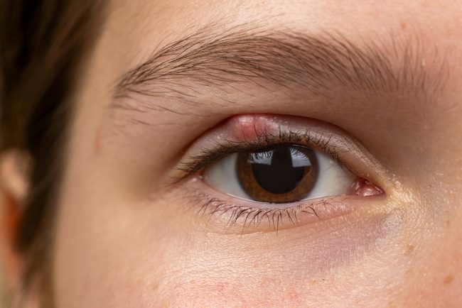 6 Cara Mengatasi Mata Bintitan dengan Aman dan Efektif - Alodokter