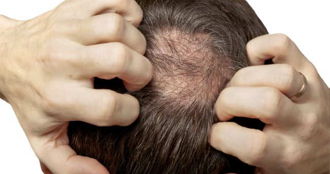 6 Vitamin untuk Rambut Rontok Terbaik - Alodokter