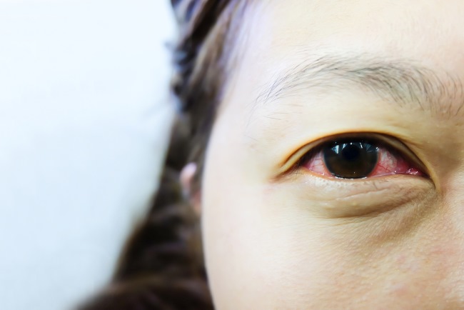 Mata Merah dan Berair, Ini Penyebab dan Cara Mengatasinya - Alodokter