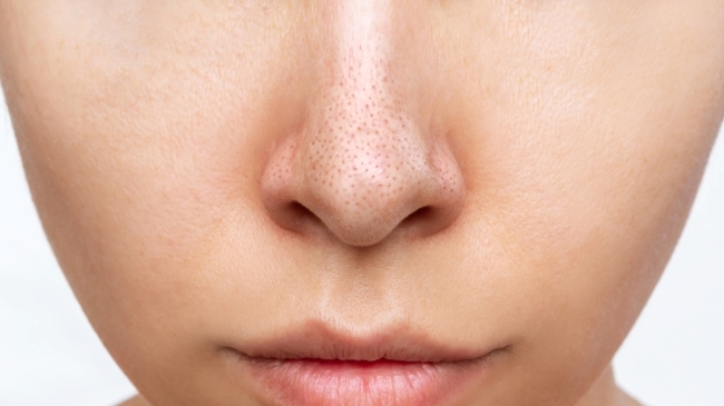 7 Cara Menghilangkan Bruntusan di Hidung yang Ampuh - Alodokter