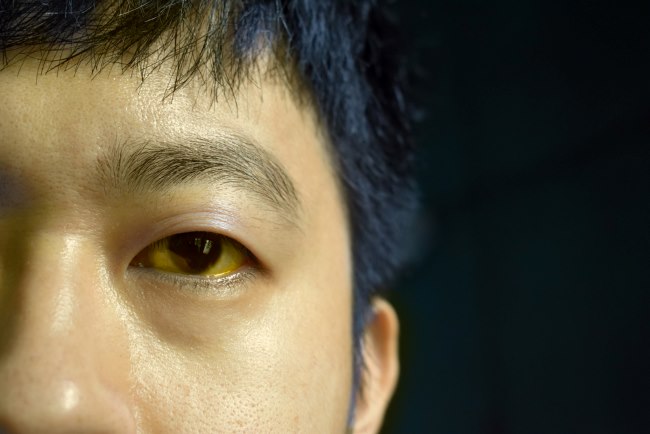 4 Cara Menyembuhkan Mata Kuning yang Aman dan Efektif - Alodokter