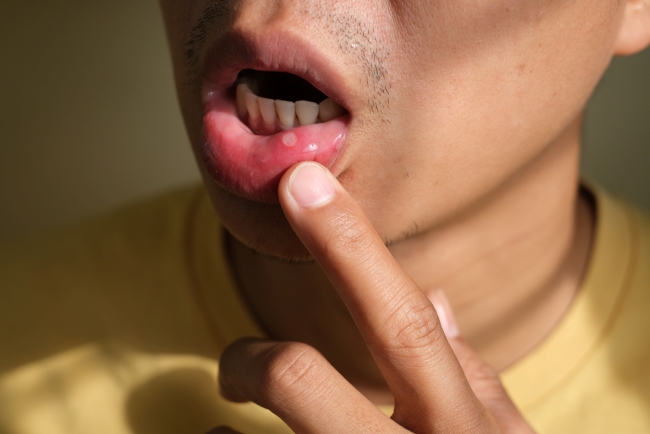 5 Pantangan Minuman untuk Sariawan yang Perlu Diketahui - Alodokter